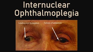 Internuclear Ophthalmoplegia [upl. by Lawson]