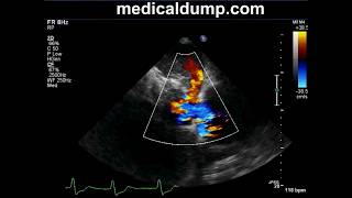 Severe Tricuspid Regurgitation  Transthoracic Echocardiogram TTE [upl. by Issor]