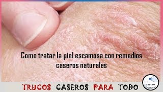 Como tratar la piel escamosa con remedios caseros naturales [upl. by Zennas]