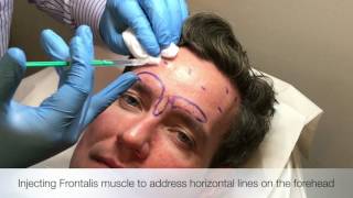 Injecting Frontalis muscle [upl. by Qifar]