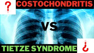 Tietze Syndrome OR Costochondritis [upl. by Sloatman]