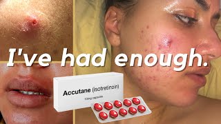 Why Im Starting Accutane Isotretinoin For My Cystic Acne 40mg Accutane Journey accutane acne [upl. by Marras]