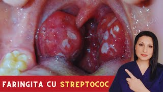 Faringita cu STREPTOCOC Tot ce trebuie sa stii [upl. by Nicolais]