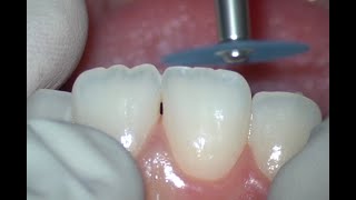 Enameloplasty Upper Central Incisors [upl. by Koren]