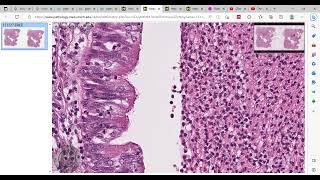 bronchopneumonia شريحة باثولوجي [upl. by Duomham380]