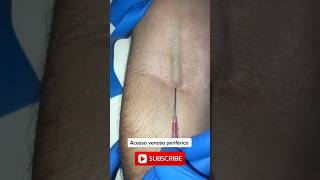 How To insert a Cannula Quick Edition Share a Save a life ❌🇧🇩👈 cannula pushing education [upl. by Khalid936]