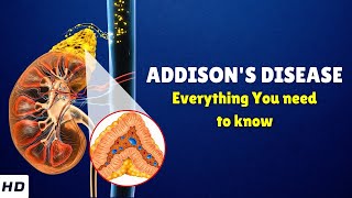 Addisons Disease – Causes Signs and Symptoms Diagnosis amp Treatment [upl. by Prudie]