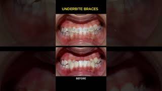 Braces process  Underbite [upl. by Jessamine]