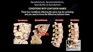 Spondylolysis Spondylolisthesis Spondylitis SpondylosisEverything Need To KnowDr Nabil Ebraheim [upl. by Ardnohsed]