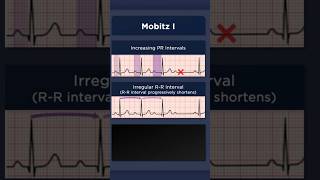 Type I Second Degree Atrioventricular Block ECG Irregular RR Intervals [upl. by Lazar162]