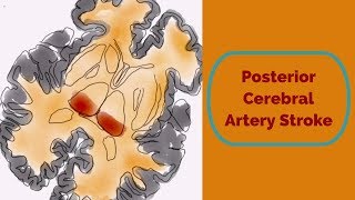 Posterior Cerebral Artery Stroke [upl. by Drogin]