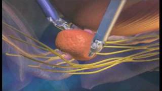 Surgery Animation da Vinci Prostatectomy [upl. by Curnin]