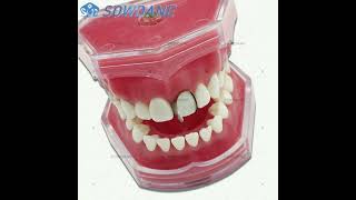 dental metal matrix matrice band [upl. by Notsur]