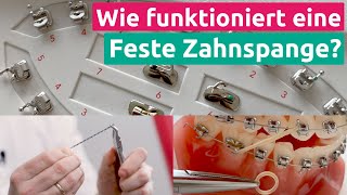 Wie genau funktioniert eigentlich eine feste Zahnspange [upl. by Jaella]