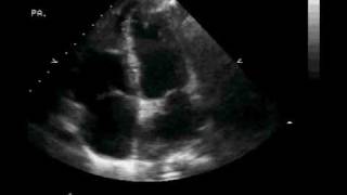 Transthoracic ECHO Apical Four Chamber View [upl. by Yi731]