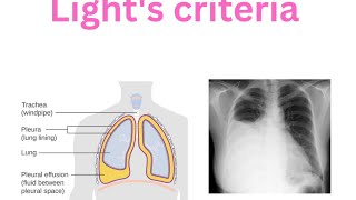 Pleura  Pleural effusion  Lights criteria  Transudate  Exudate Empyema [upl. by Oaoj]