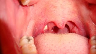 Tonsil Stones  How to Remove Tonsil Stones [upl. by Nick]