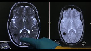 Cavernous malformations — Neurovascular disease explained [upl. by Gnut969]