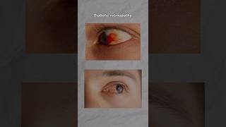 Diabetic retinopathy in 30 secs [upl. by Carper999]