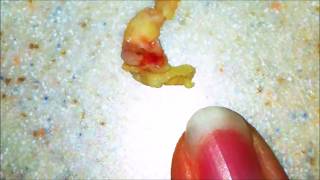 Worlds Largest Tonsil Stones  Cured [upl. by Ymme]