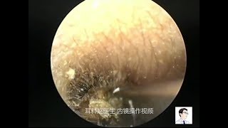 Ear canal treatment for childrens external ear canal by ear endoscope 12 minutes [upl. by Singband224]