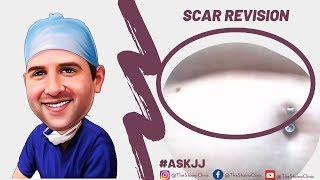 Can an indented scar be removed [upl. by Iras]