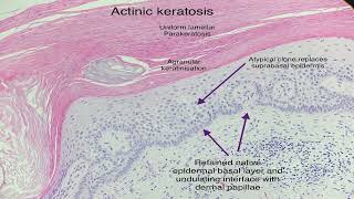 actinic keratosis [upl. by Amre]