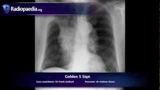 Golden S sign  radiology video tutorial xray [upl. by Ylrebmek]