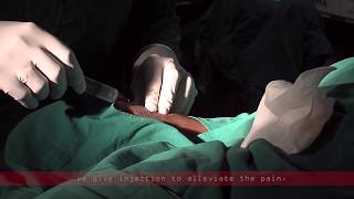 Coronary angiogram  a live demonstration [upl. by Ysnat]