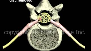 Lumbar Discectomy disc removal and Fusion  Narration and Animation by Cal Shipley MD [upl. by Brooke]