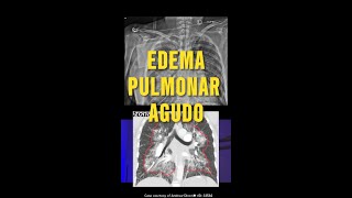 Edema Pulmonar Caso Clínicomedicina Radiología Medicina CasoClínico estudiantemedicina [upl. by Grekin]