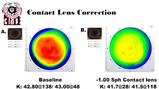 Anisometropia and Aniseikonia Treatment [upl. by Anstice45]