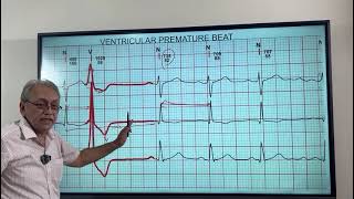 VENTRICULAR ECTOPICS  VENTRICULAR PREMATURE BEATS HOW TO DIAGNOSE ON ECG [upl. by Mallorie]