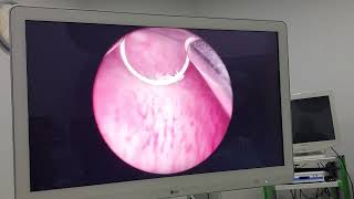 Chronis Cystitis Treatment with Bladder Fulguration [upl. by Robinet]