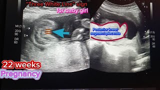 baby girl with posterior placenta [upl. by Lamdin]