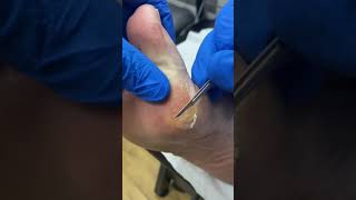 Say Goodbye to Bunion Pain Hard Skin and Callus Removal by Australian Podiatrist [upl. by Ayaros]