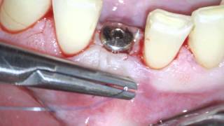 Implant uncovery and soft tissue augmentation [upl. by Navada225]