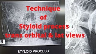 Technique of styloid processEp34 Styloid trans orbital view amp lateral view I Tutorial [upl. by Caddaric565]