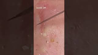 Pickel Ausdrücken Spa  Blackheads Akne amp Mitesser entfernen 🔴 79 [upl. by Allesor746]