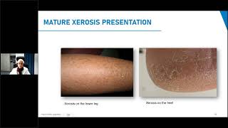 CeraVe SkinChat Mature Xerosis Patients Considerations and Tips for Epidermal Barrier Maintenance [upl. by Ursula459]