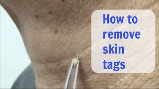 Painless Cryo Skin Tags removal  Cosmetic Institute of Australia [upl. by Mazel615]