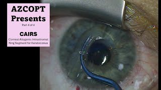 CAIRS Corneal Allogenic Intrastromal Ring Segment Case 4 [upl. by Llatsyrc]