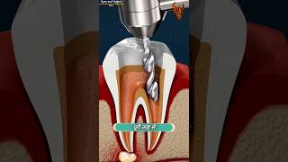 How Root Canal Works 😯  रूट कैनाल कैसे काम करता है  shorts [upl. by Gonick]