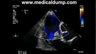 Tricuspid Valve Fibroelastoma  TransEsophageal Echocardiography TEE [upl. by Orravan]