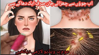 lice removal home remedies in one daylice nikalne ka tarika [upl. by Laurice]