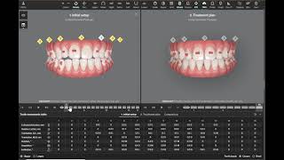 Invisalign ClinCheck  Need for extrusion attachments [upl. by Kreitman431]