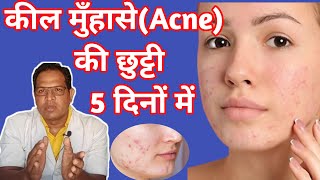 Pimple गायब हो जायंगे  adapalene and clindamycin phosphate gel  Cream For acne and Pimple [upl. by Oirasan]