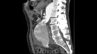 Aortic Aneurysms amp Marfans Syndrome Learn All about Potentially LifeThreatening Aortic Aneurysms [upl. by Katzir]