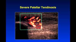 Introduction to Musculoskeletal Ultrasound [upl. by Natsirhc]