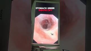 Understanding Stomach Ulcers An InDepth Look Under Endoscopy [upl. by Ykcir793]